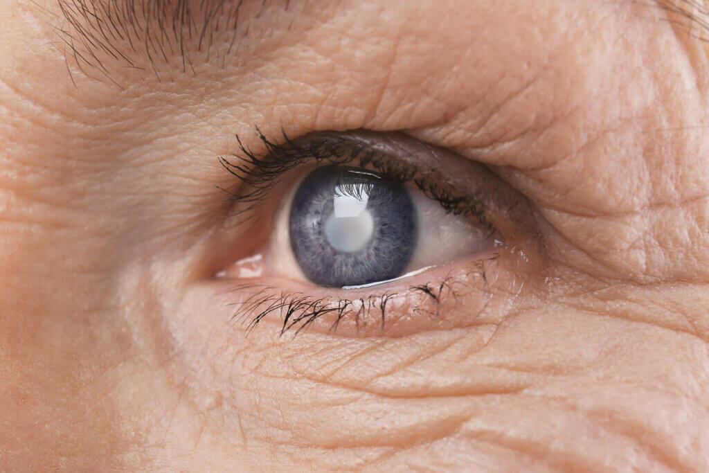 Die Operation des Grauen Stars (Katarakt)