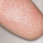 Mikroimplantat iStent die Revolution beim Gruenen Star