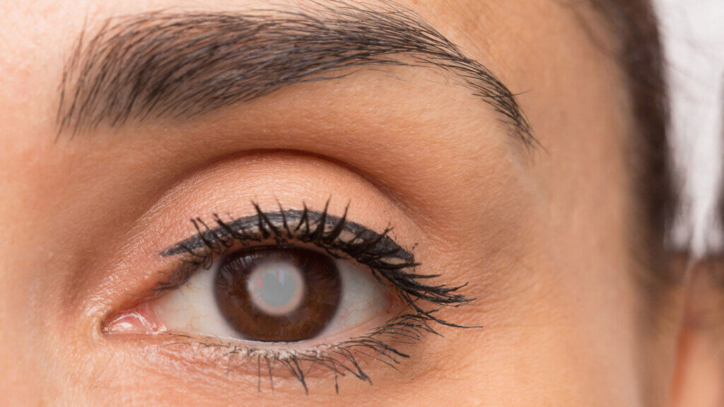 Eingetrübte Linse bei grauem Star