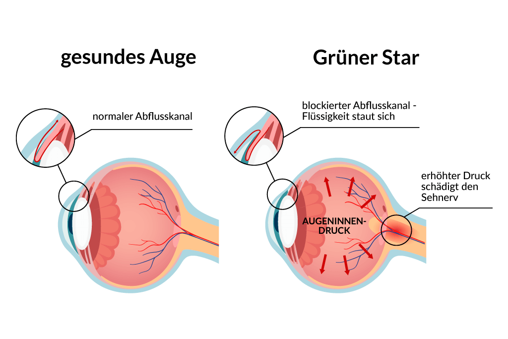 Grüner Star Welche Formen gibt es?