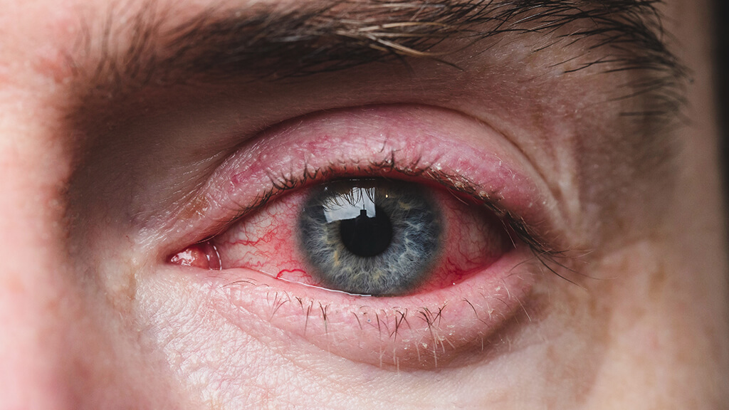 Augenkrankheiten Hornhautentzündung (Keratitis) - Dr. Bányai