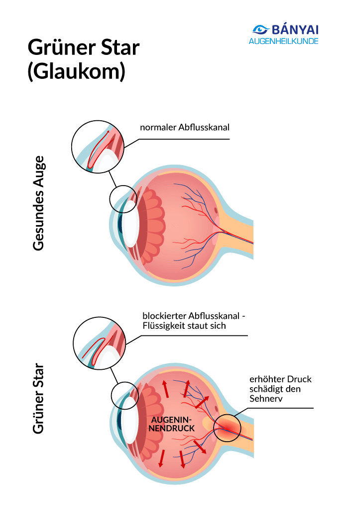 Grafik und Darstellung Glaukom und gesundes Auge